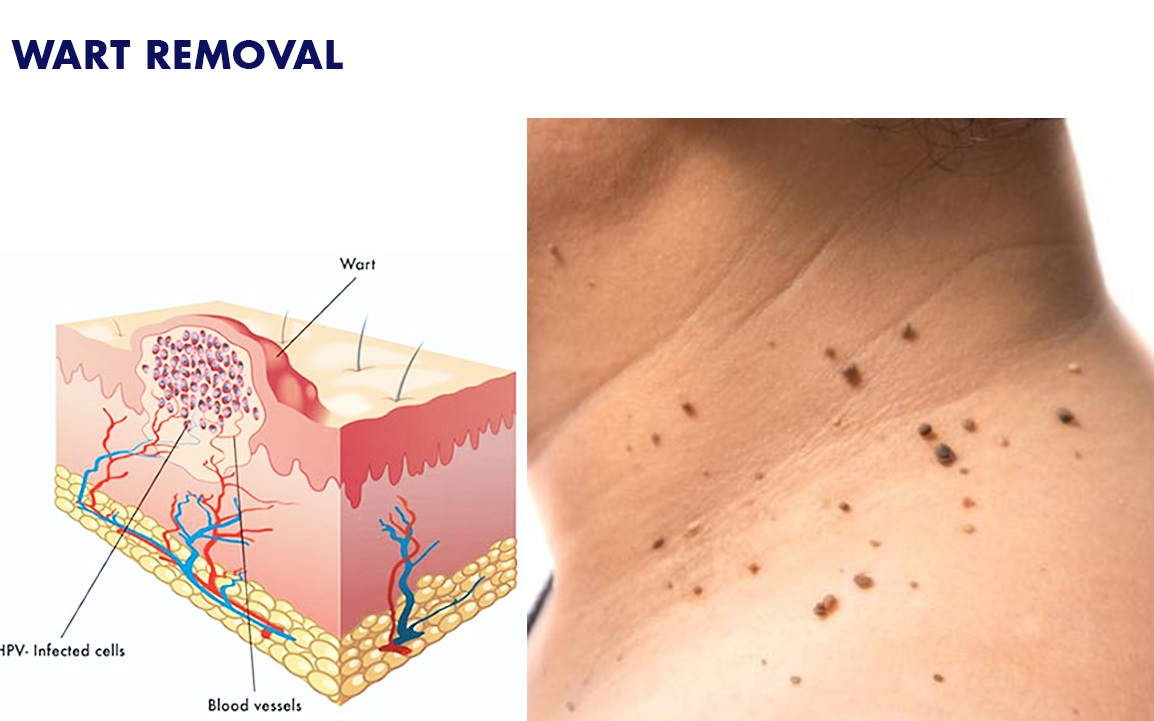 SKIN TAG / WART REMOVAL